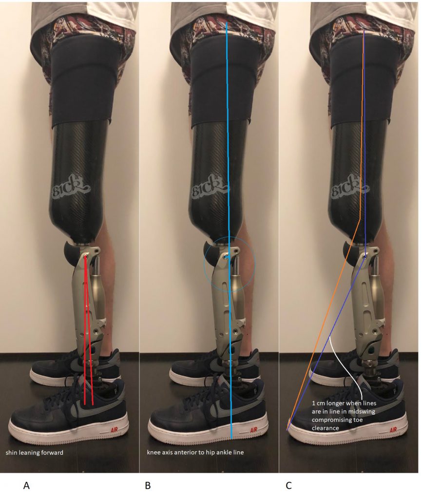 How to look at alignment in a through knee application – VGK Very Good Knee